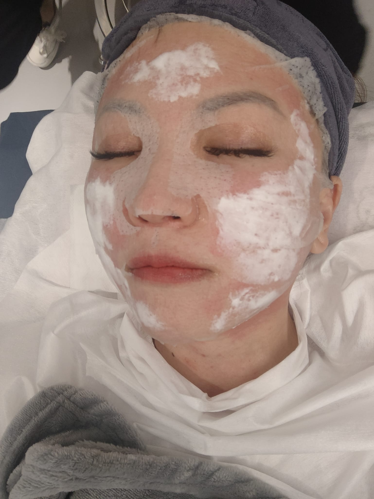 【醫美】今年生日也來恆美學!謝謝韓國帥歐巴院長 鄒承軒 讓我找回自信了!! - 第14張圖